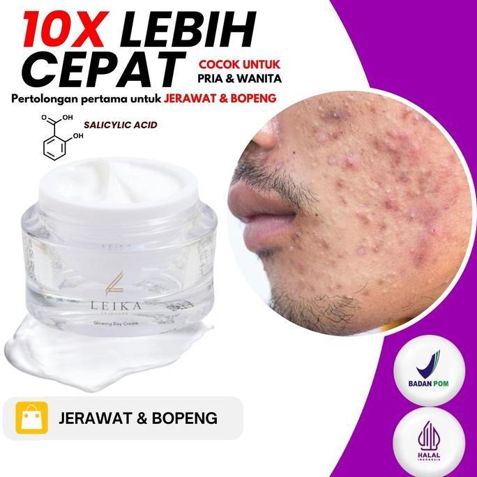Krim pagi Leika Skincare dirancang khusus untuk mengatasi jerawat bopeng krim jerawat bopeng obat je