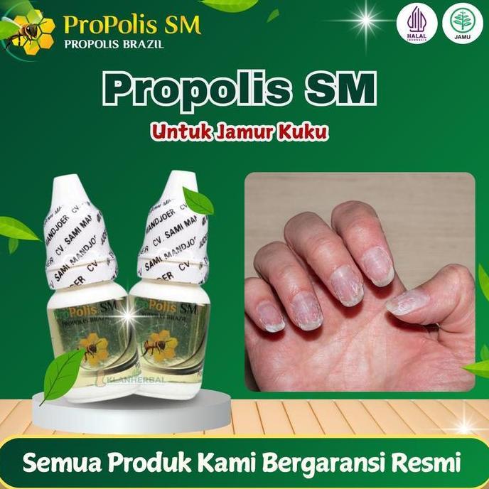 Jamur Kuku, Cantengan jempol Kuku, Kuku bernanah, Kuku berair, Psoriasis Kuku Propolis SM 6 ml