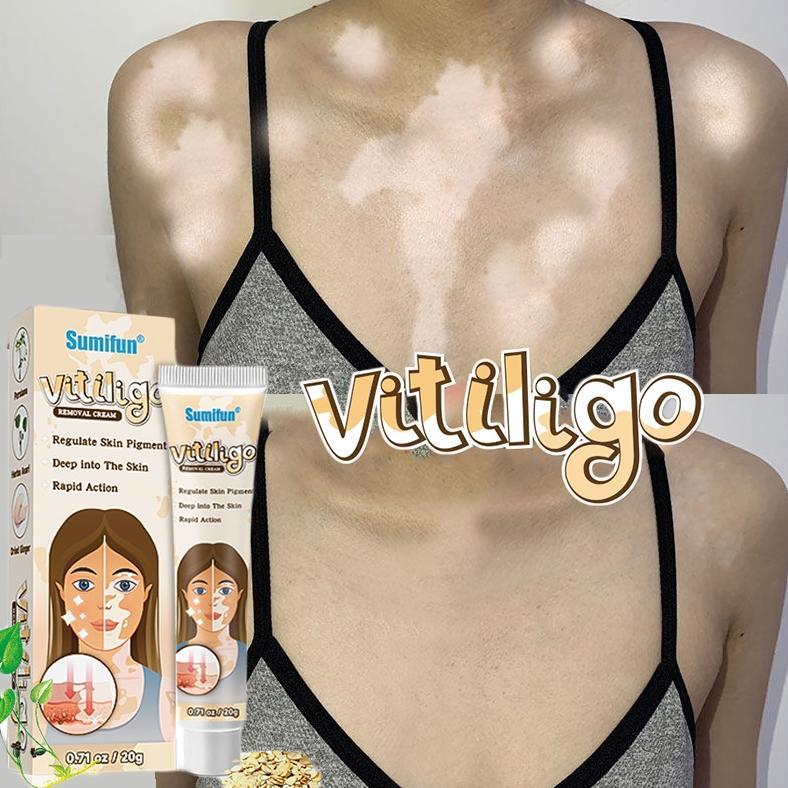 NEW Salep vitiligo Obat vitiligo paling ampuh 100% Obat vitiligo Obat bercak putih pada kulit Protop