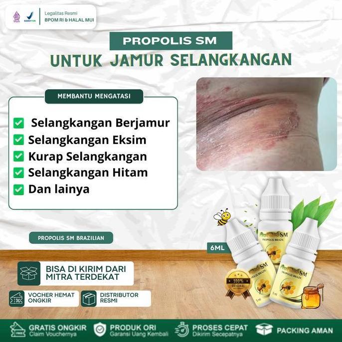 Propolis SM Solusi Untuk Mengatasi Selangkangan Berjamur, Gatal Selangkangan, Selangkangan Eksim, Ku