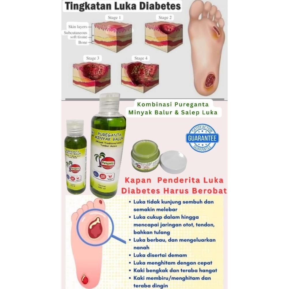 Pureganta - Minyak Oles Ampuh Luka Diabetes kering/Luka Diabetes basah/Obat Luka  Dekubitus/Obat Luk