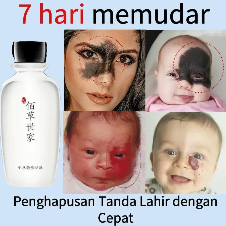 Terlaris Memudarkan Tanda Lahir Obat Penghilang Tanda Lahir Coklat, Merah, Hitam Hemangioma Tanda La