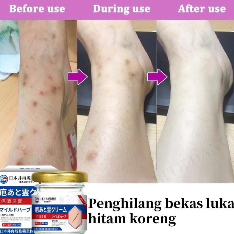 Penghilang bekas luka hitam koreng Penghilang bekas luka di kaki Bekas luka bakar Bekas lama Keloid