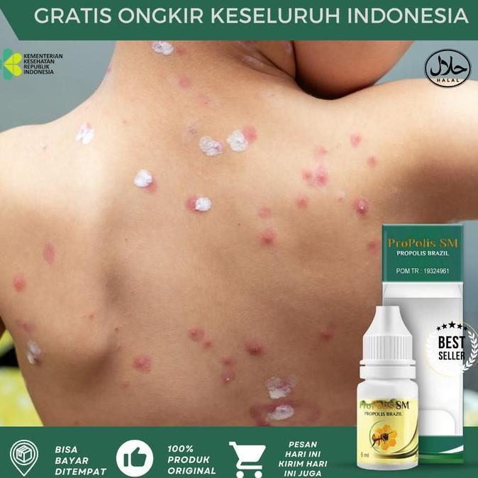 Propolis SM Obat Salep Cacar Air Anak Dan Dewasa, Penghilang Bekas Luka Cacar Lama, Cacar Air Gatal 