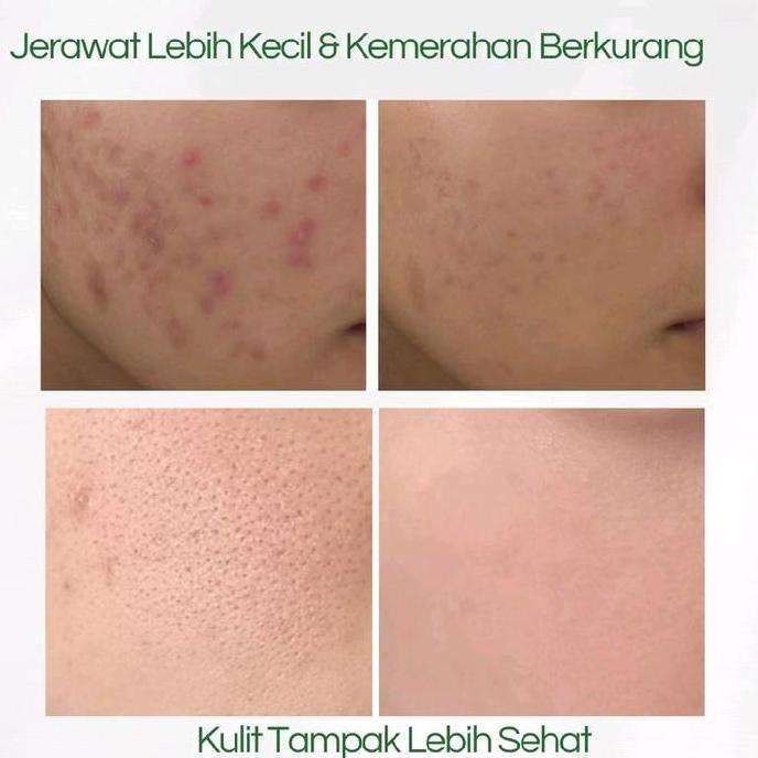 SALEP SCABIES OBAT SCABIES  OBAT GATAL SCABIES SALEP GATAL SCABIES ORI
