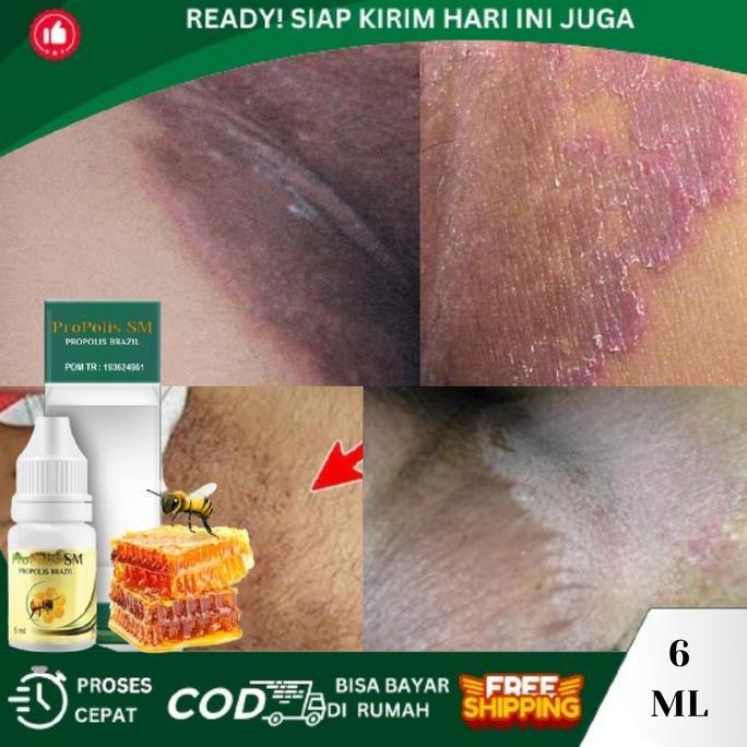 Selangkangan Hitam, Pemutih Selangkangan Alami, Salep Penghilang Selangkangan Hitam, Pembersih Jamur