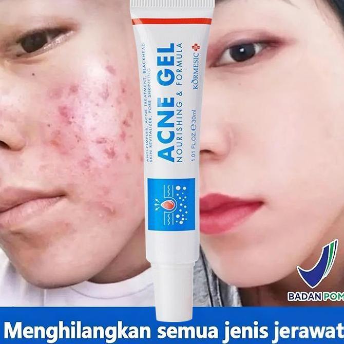 Karens.Tbks - BpomAcnes Sealing Jell 30Gr Salep Acnes Penghilang Jerawat Dan Bekasjerawat - Salicyli