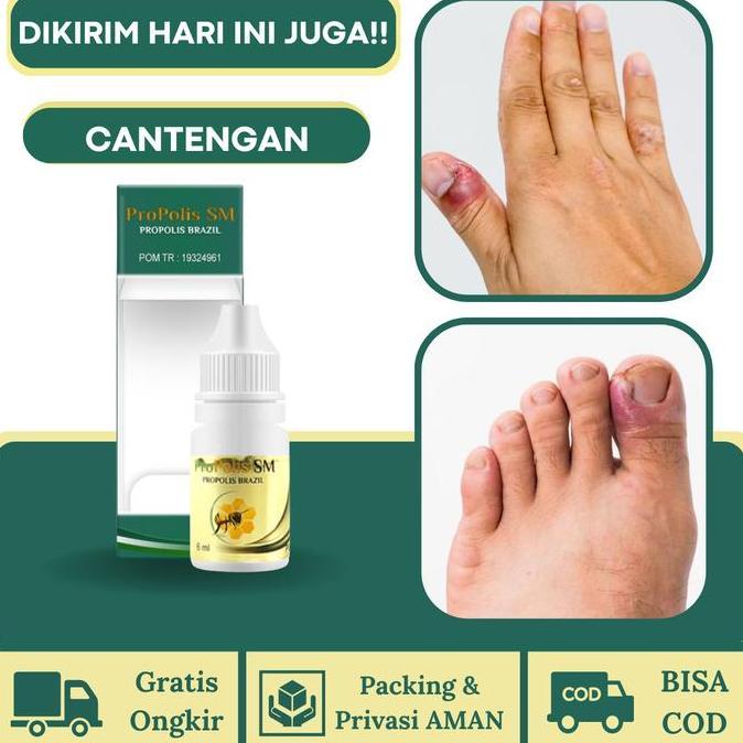 ProPolis SM Cantengan Jempol Kaki dan Jamur Kuku Kaki, Kuku Busuk Dan Hitam