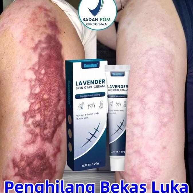 Salep penghilang bekas luka Penghilang bekas luka hitam koreng Obat penghilang bekas luka Menghilang