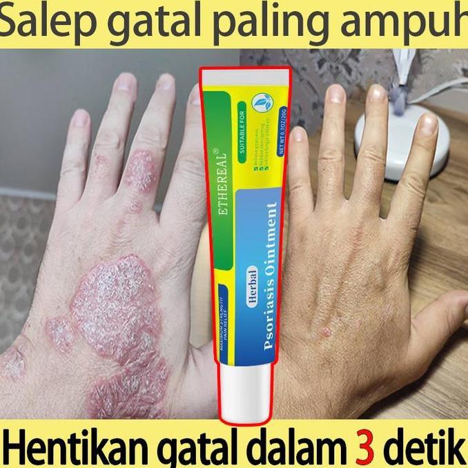 salep eksim kering salep gatal gatal cream psoriasis salep psoriasis