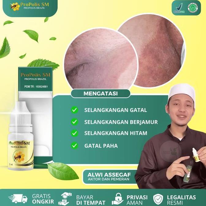 Propolis SM Gatal Selangkangan Dan Miss V, Selangkangan Berjamur Hitam, Selangkangan Gatal Dan Lecet