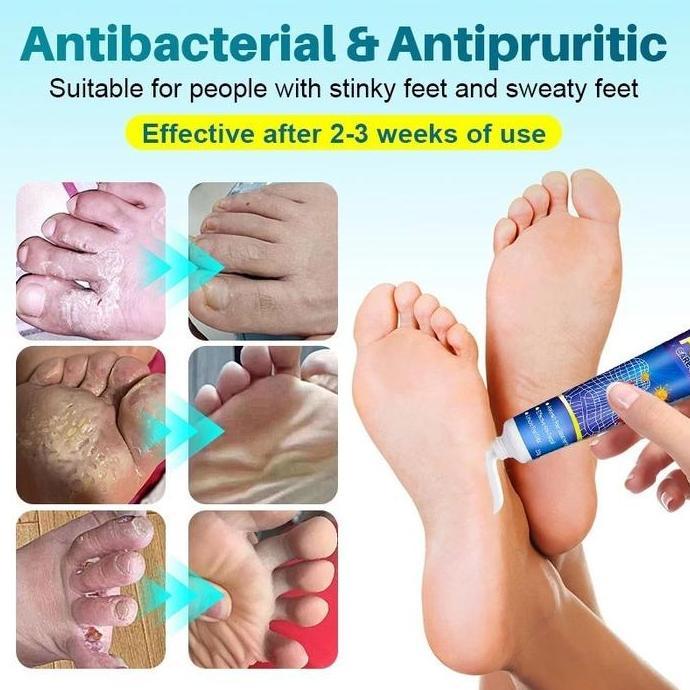 Cod,Bisa- Obat Jamur Kaki P Penghilang Bau Kaki Anti Jamur Kaki Gatal&Kurap/Obat Jamur Kaki/Henti Ga