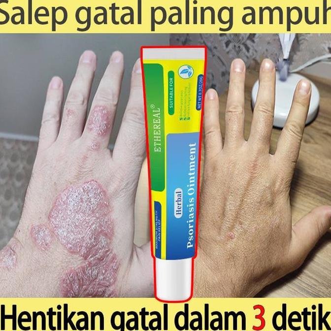 salep eksim kering salep gatal gatal cream psoriasis salep psoriasis