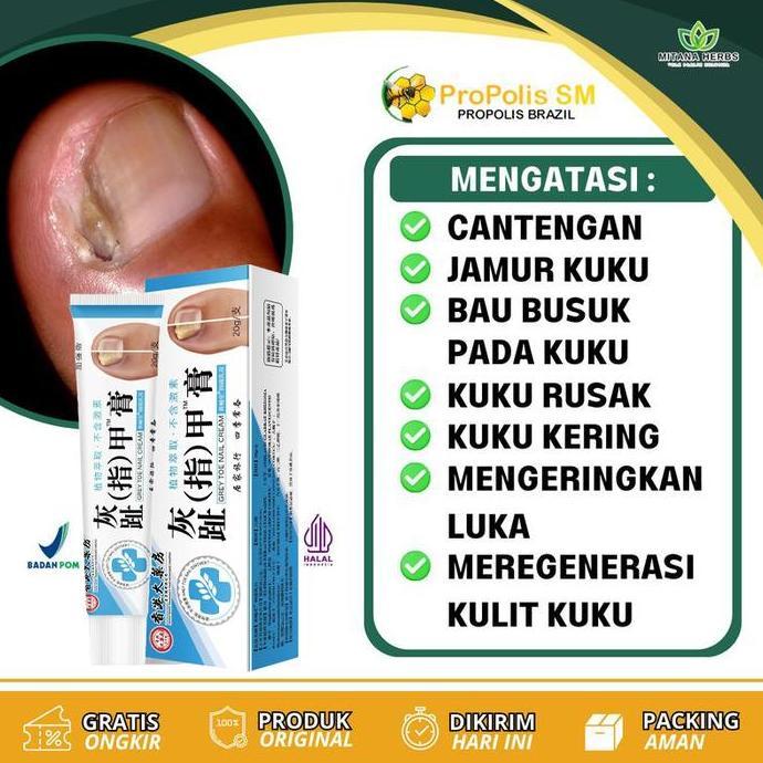 Obat Kuku Obat Jamur Kuku Perawatan Jamur Kuku Rusak Berjamur Nail Care Anti Jamur Perawatan Kuku ob