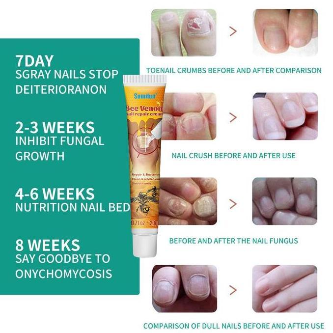 Spika- Salep Kuku Jamur 20G - Obat Kutil Kaki & Kuku Hitam Atasi Kuku Rapuh & Kuning Bpom Terdaftar 
