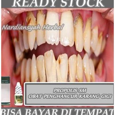 Obat Penghancur Karang Gigi, Karang Gigi Gusi, Pembersih Karang Gigi