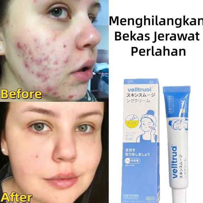 Karens.Tbks - Salep Jerawat Penghilang Jerawat Bekas Jerawat Dan Bekas Jerawat Hitam Membandel Mengu