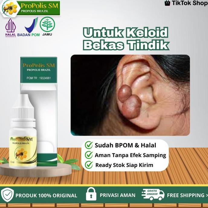 Propolis SM - Untuk Penghilang Keloid Bekas Luka Menonjol Di Telinga,  Keloid Menonjol Bekas Tindik 