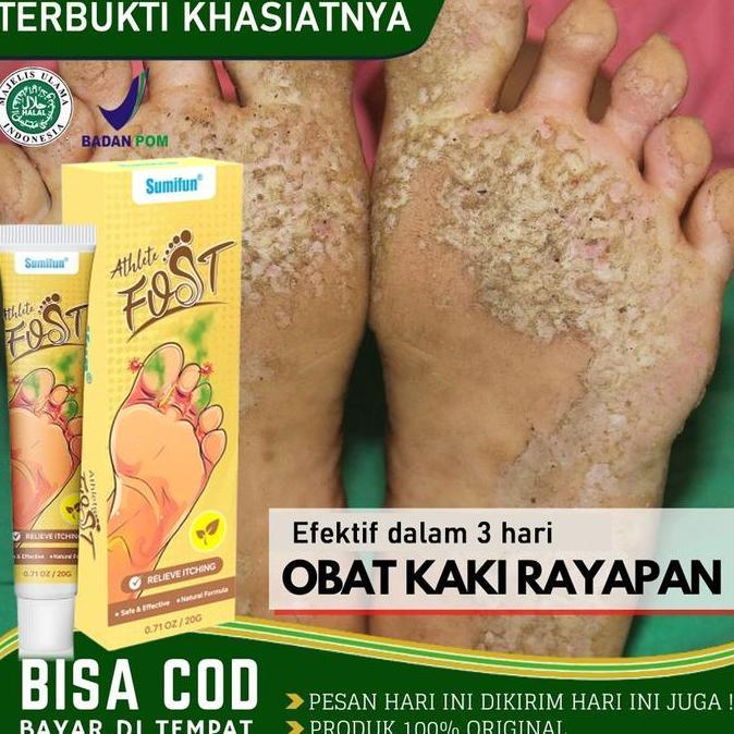 Cod,Sis- P Gatel Paling Obat Telapak Kaki Rayapan 0G P Gatal Kulit Ampuh Obat Kaki Rayapan Bolong Pa