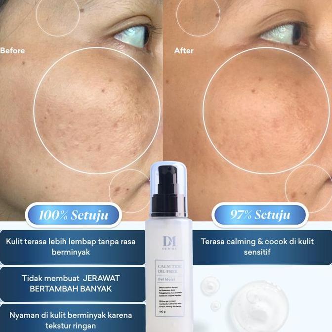 Dew Me Calm Tide Moisturizer Gel Ringan Kulit Berminyak Jerawat Sensitif Pelembab Acne NO Ceramide &