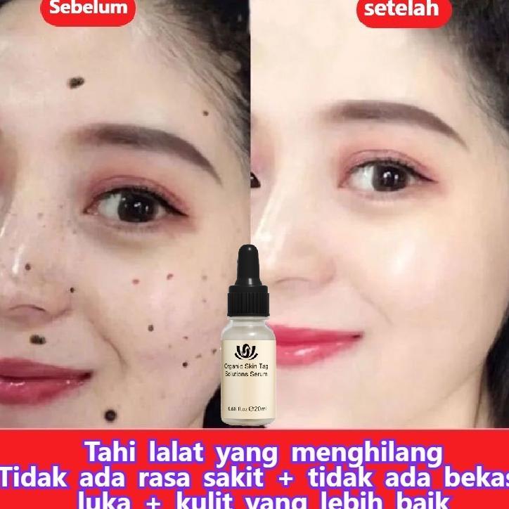 Penghilang Tahi Lalat Penghilang Kutil Penghilang Tahi Lalat Di Wajah Obat Penghilang Tahi Lalat Ski