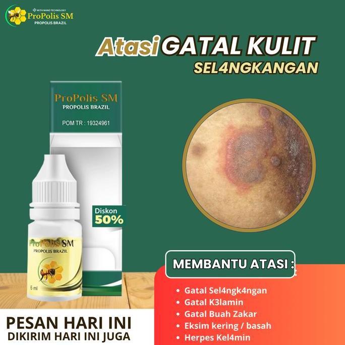 Propolis SM Penghilang Gatal Selangkangan, Gatal K3lamin, Gatal Beruntusan di Pantat, Penghilang Eks