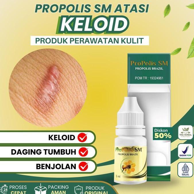 Propolis SM Atasi Keloid Berkerut, Injeksi,  Luka tindik dan Keloid Menonjol Tahunan Aman Untuk Anak
