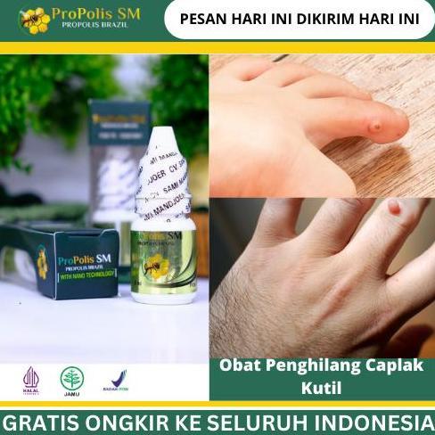 Herbal ProPolis Caplak Kutil, Penghilang Kutil Daging Tumbuh, Kutil Papiloma, Bintik Bintik di Jari,