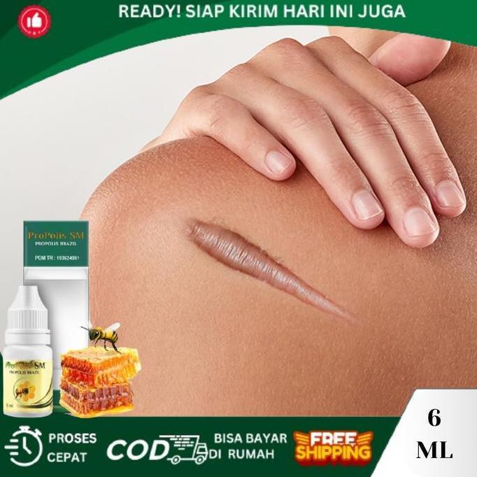 Bekas Luka Menonjol, Penghilang Keloid Berkerut, Keloid Menonjol Tahunan, Keloid Di Dada, Keloid Dag