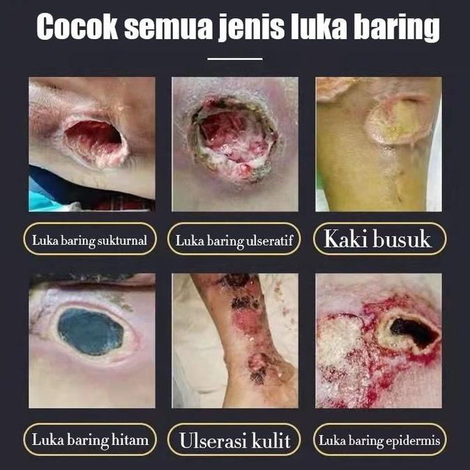 Krem pelembap tubuh melembapkan Luka Diabete Skrim Dekubitus Mengobati Dekubitus 20g Penyembuhan Luk