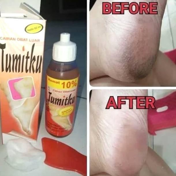 NEW (COD) Obat Tumit Kaki Paling Ampuh, Obat Kapalan, Obat Telapak Kaki Pecah-pecah Kasar Kering [te