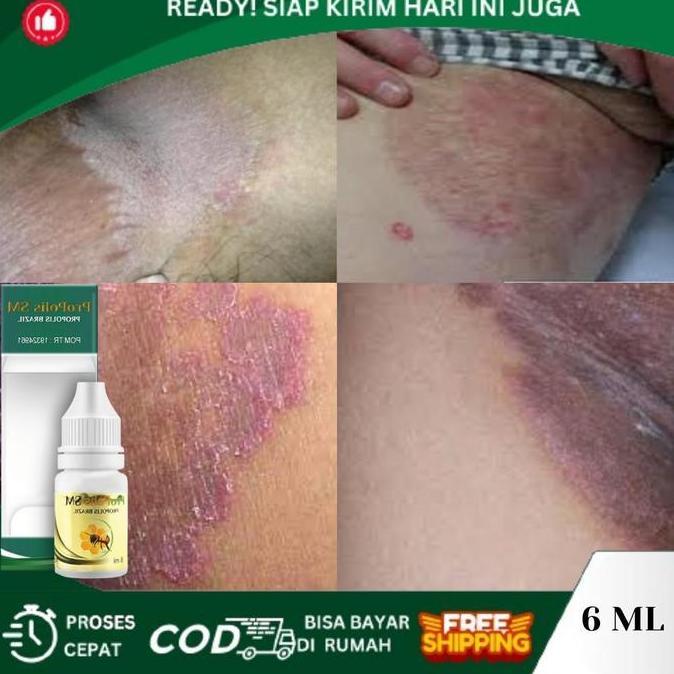 Gatal Selangkangan, Selangkangan Hitam, Selangkangan Gatal Dan Hitam, Ruam Merah Selangkangan, Pemut