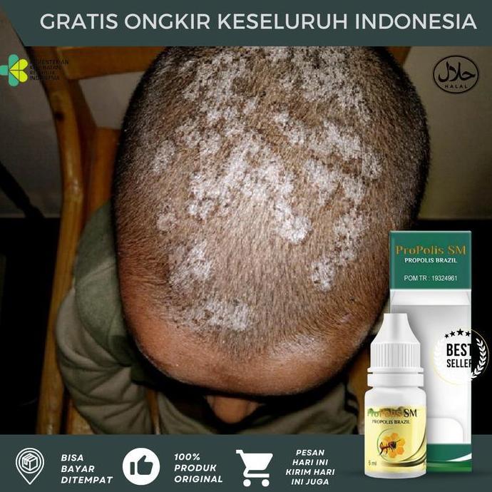 Tinea Capitis Pada Anak, Tinea Cruris, Tinea Capitis Jamur Kepala Anak, Borok Kepala, Jamur Kulit Ke