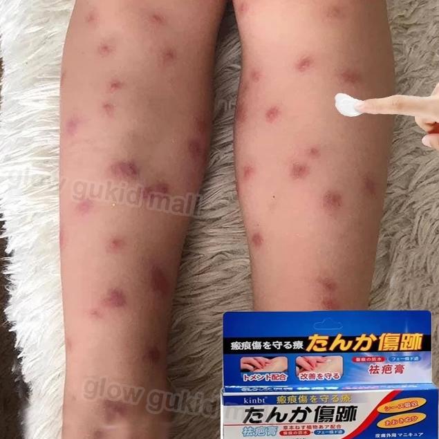 Terlaris penghilang bekas luka hitam koreng menghilangkan bekas luka menghitam bekas gigitan nyamuk 