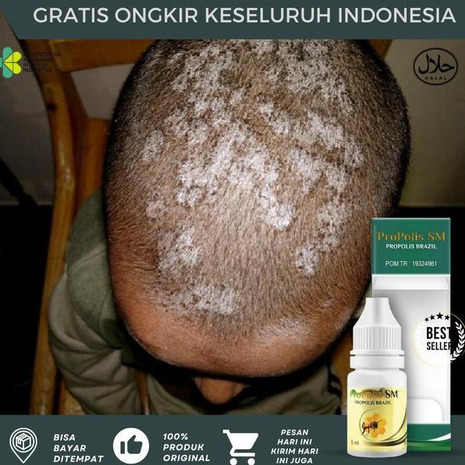 Tinea Capitis Pada Anak, Tinea Cruris, Tinea Capitis Jamur Kepala Anak, Borok Kepala, Jamur Kulit Ke