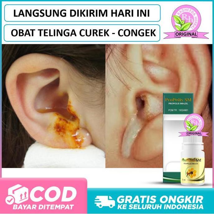 Obat Telinga Congek, Curek, Berdenging, Bernanah, Berair Kuning Bau