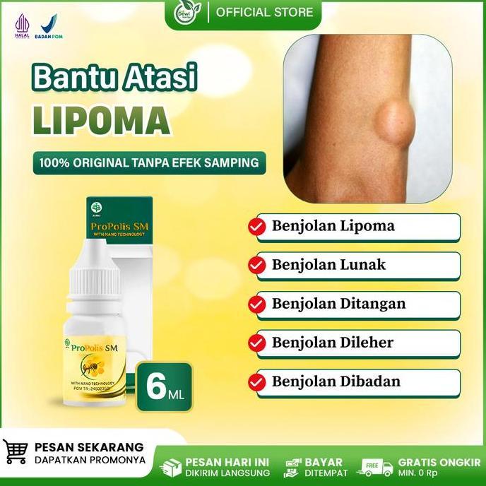 Youyou- Propolis Sm Herbal Untuk Lipoma Di Punggung, Benjolan Lemak Lipoma Pecah, Tumor Jinak Pada A