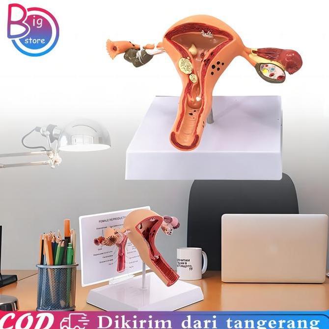 PARANE Uterus Ovary Anatomical Model Anatomy Alat Peraga Anatomi Model Patologis Uterus Ovarium Mane