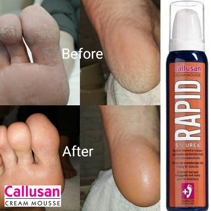 NEW Rough Skin Kapalan Callusan Cream Mousse Rapid Foam Non Krim 125ml Non Gehwol Pedicure [terbaik]