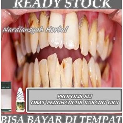 Obat Penghancur Karang Gigi, Karang Gigi Gusi, Pembersih Karang Gigi
