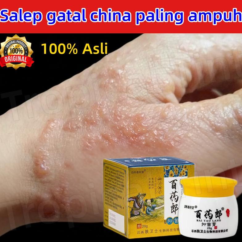 Terlaris Salep gatal china paling ampuh salep gatal jamur selangkanga Krim Eksim Bayi dan Anak Obat 