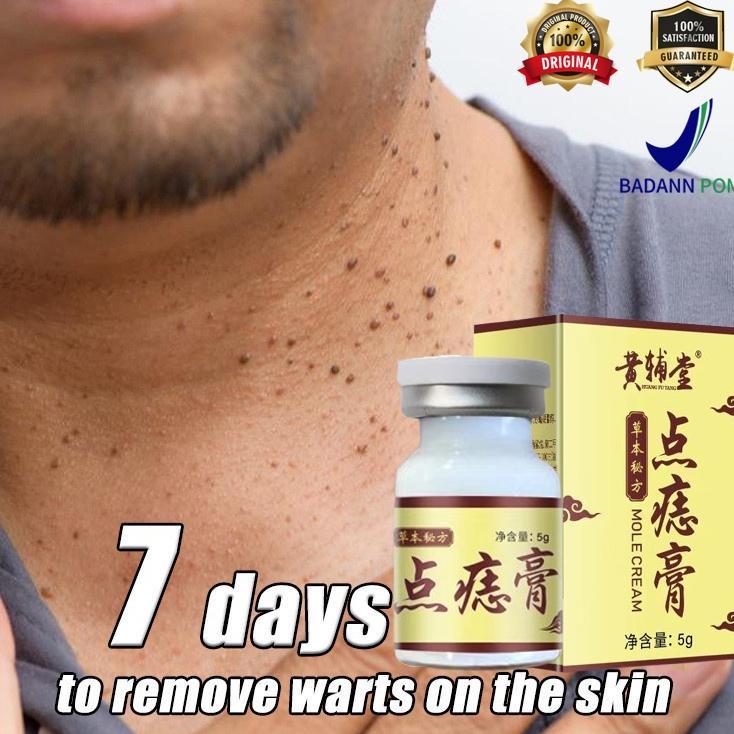 Terlaris Obat Kutil paling ampuh Oles Kutil paling ampuh Wart Removal Cream Krim Penghilang Lalat Pe