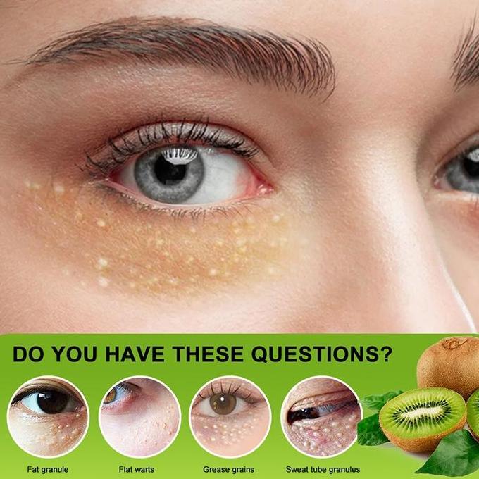 Youme- Krim Penghilang Milia Syringoma Xanthelasma Butiran Lemak Sekitar Mata