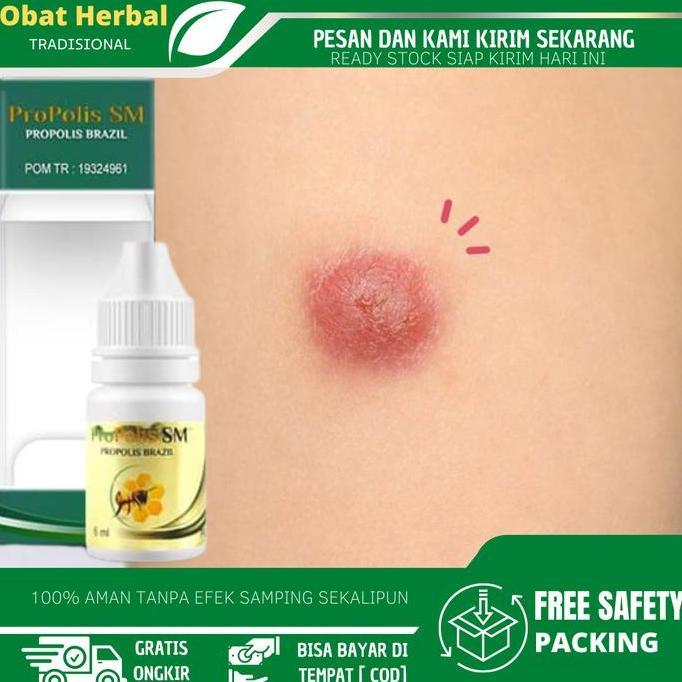 Salep Bisul Biar Gak Tumbuh Lagi, Bisul Untuk Anak, Bisul Di Pantat, Bisuk Di Ketiak, Bisul Di Kemal