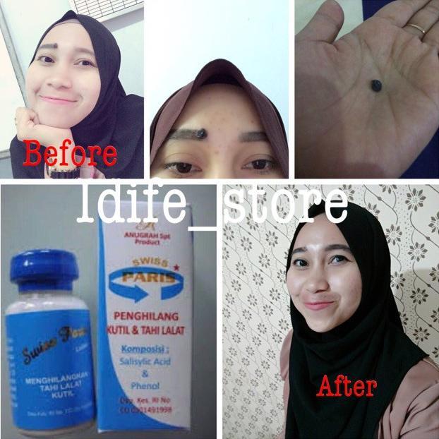 NEW Penghilang Kutil Penghilang Tahi Lalat Hidup Penghilang Tahi Lalat Mati [terbaik][terlaris]