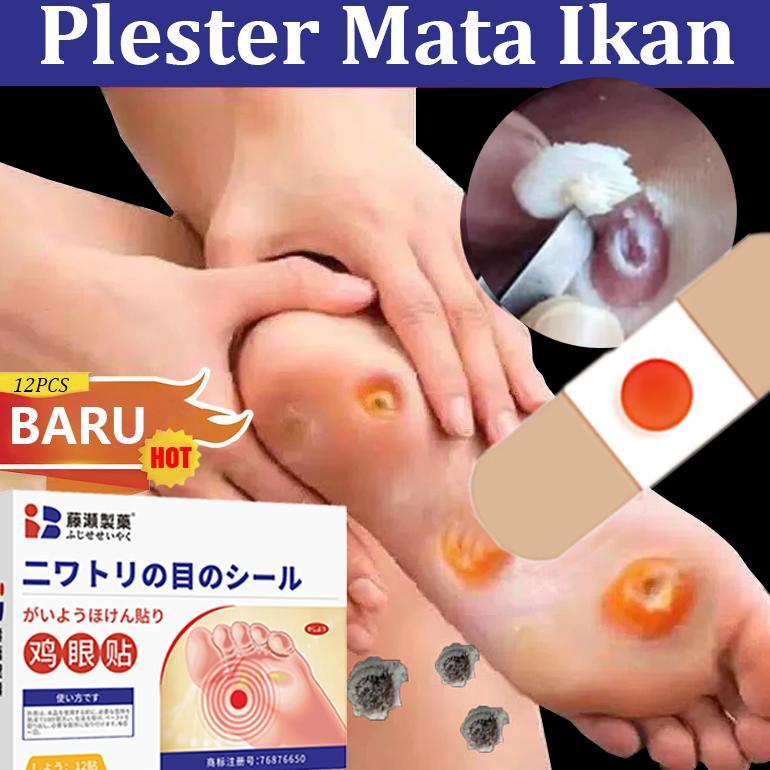 Terlaris Plester Mata Ikan Paling Ampuh Jepang 0bat Mata Ikan Di Kaki Penghilang Mata Ikan Di Tangan