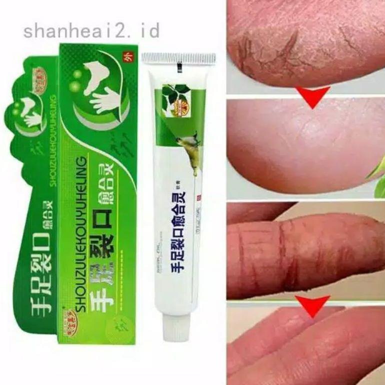 Terlaris Obat Telapak Kaki Pecah-Pecah Kapalan Dan Kutu Air