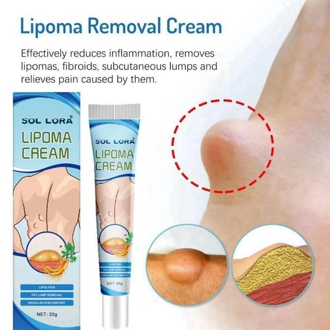 Haut- Obat Benjolan Lipoma Salep Benjolan Tiroid Cream Penghilang Lipoma Herbal 20G Krim Lipoma Crea
