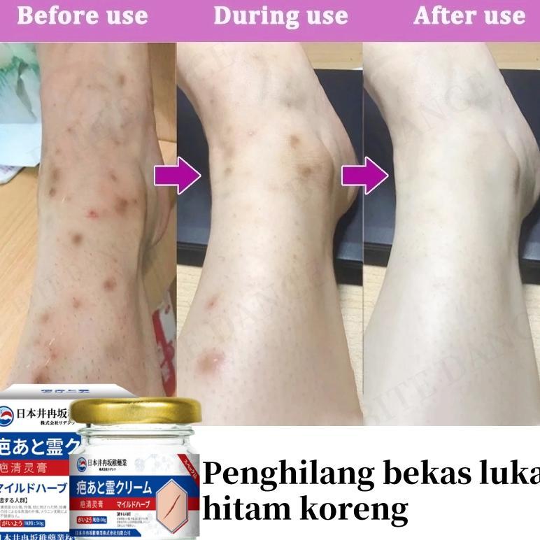 Penghilang Bekas Luka Hitam Koreng Penghilang Bekas Luka Di Kaki Bekas Luka Bakar Bekas Lama Keloid