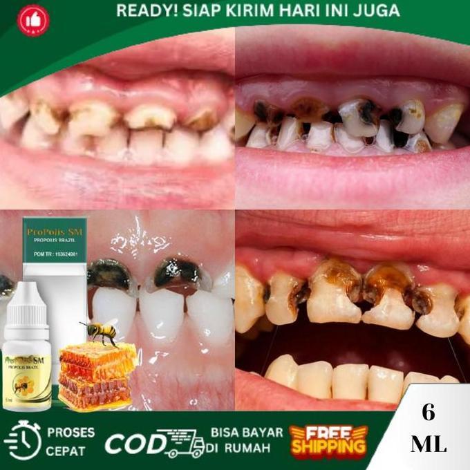 Perontok Gigi Rusak Hitam Berlubang, Gigi Rusak Pada Anak, Gigi Hitam, Gigi Keropos, Herbal Gigi Rus